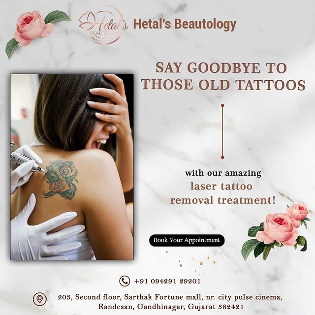 Tattoo Removal